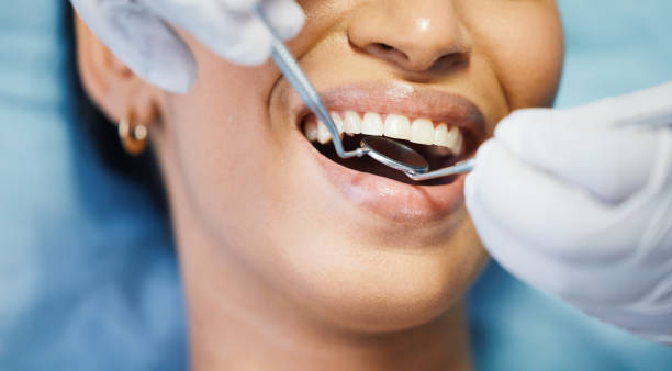 Teeth Whitening in NC